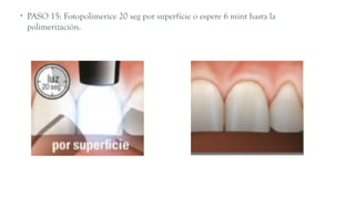 • PASO 15: Fotopolimerice 20 seg por superficie o espere 6 mint hasta la
polimerización.
 