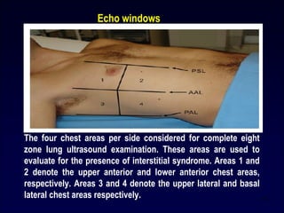The four chest areas per side considered for complete eight
zone lung ultrasound examination. These areas are used to
evaluate for the presence of interstitial syndrome. Areas 1 and
2 denote the upper anterior and lower anterior chest areas,
respectively. Areas 3 and 4 denote the upper lateral and basal
lateral chest areas respectively. 14
Echo windows
 