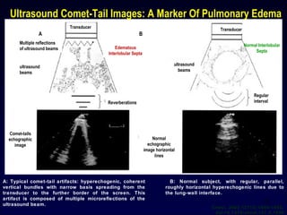Multiple reflections
of ultrasound beams
ultrasound
beams
ultrasound
beams
Comet-tails
echographic
image
Normal
echographic
image horizontal
lines
Regular
intervalReverberations
Transducer Transducer
Edematous
Interlobular Septa
Normal Interlobular
Septa
Ultrasound Comet-Tail Images: A Marker Of Pulmonary Edema
A: Typical comet-tail artifacts: hyperechogenic, coherent
vertical bundles with narrow basis spreading from the
transducer to the further border of the screen. This
artifact is composed of multiple microreflections of the
ultrasound beam.
A B
B: Normal subject, with regular, parallel,
roughly horizontal hyperechogenic lines due to
the lung-wall interface.
Chest. 2005;127(5):1690-1695.
doi:10.1378/chest.127.5.1690
15
 