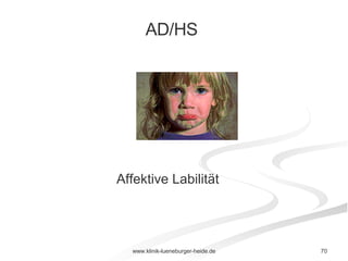 Affektive Labilität AD/HS  