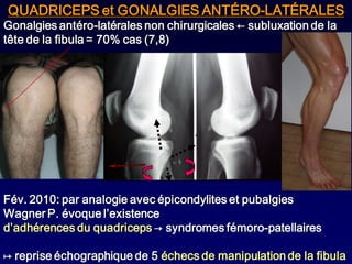 QUADRICEPS et GONALGIES ANTÉRO-LATÉRALES
Gonalgies antéro-latérales non chirurgicales ← subluxation de la
tête de la fibula ≃ 70% cas (7,8)




Fév. 2010: par analogie avec épicondylites et pubalgies
Wagner P. évoque l’existence
d’adhérences du quadriceps → syndromes fémoro-patellaires

↦ reprise échographique de 5 échecs de manipulation de la fibula
 