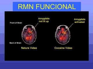 RMN FUNCIONAL
 