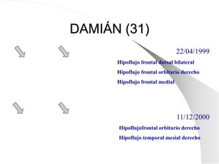 DAMIÁN (31)
22/04/1999
Hipoflujo frontal dorsal bilateral
Hipoflujo frontal orbitario derecho
Hipoflujo frontal medial
11/12/2000
Hipoflujofrontal orbitario derecho
Hipoflujo temporal mesial derecho
 