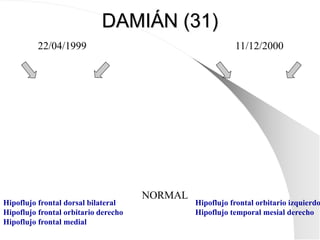 DAMIÁN (31)
22/04/1999 11/12/2000
NORMAL
Hipoflujo frontal dorsal bilateral
Hipoflujo frontal orbitario derecho
Hipoflujo frontal medial
Hipoflujo frontal orbitario izquierdo
Hipoflujo temporal mesial derecho
 