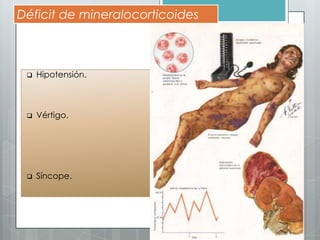Déficit de mineralocorticoides



    Hipotensión.



    Vértigo.




    Síncope.
 