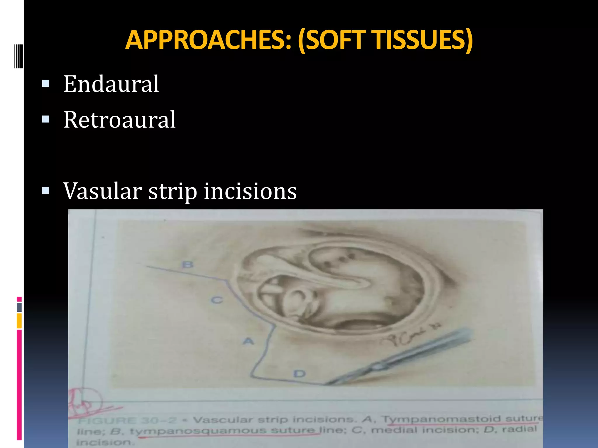 Canal wall up Mastoidectomy ( Intact Bridge Mastoidectomy) by Dr.Aditya ...