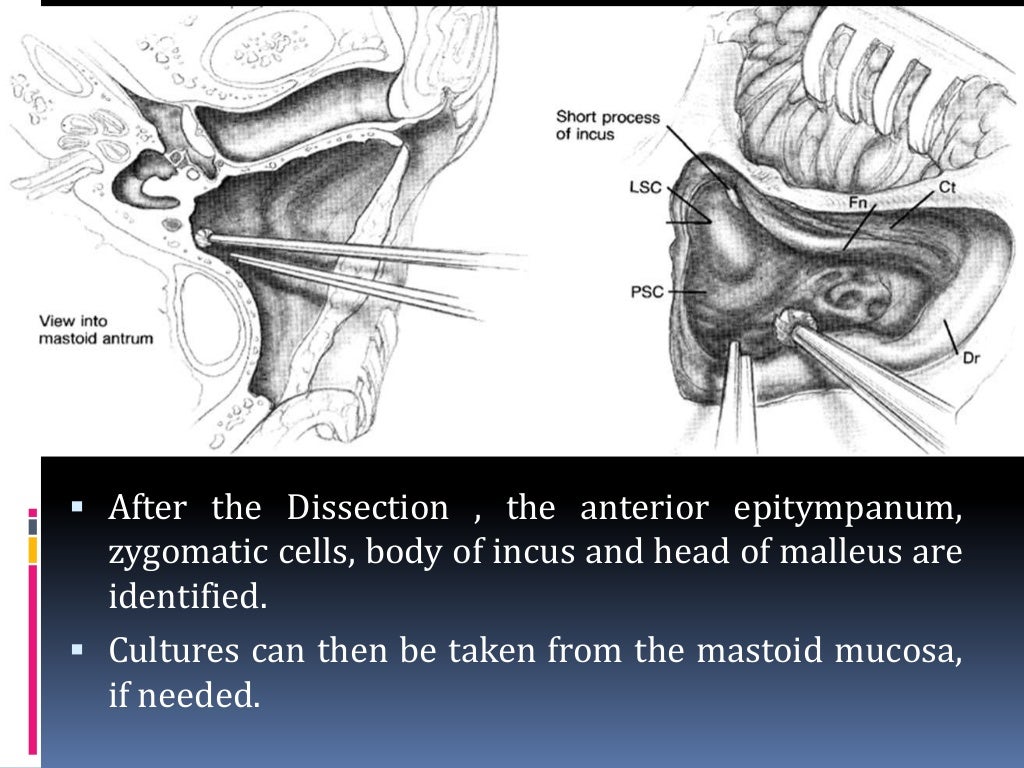 Canal wall up Mastoidectomy ( Intact Bridge Mastoidectomy) by Dr.Adit…