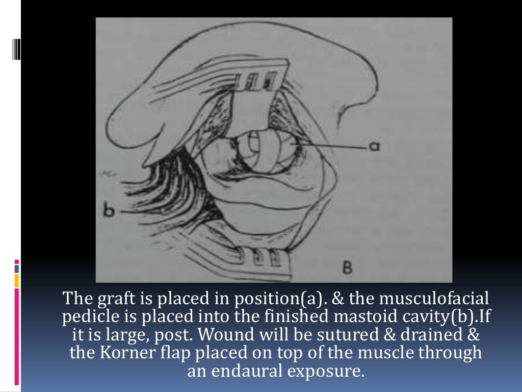 Canal wall up Mastoidectomy ( Intact Bridge Mastoidectomy) by Dr.Adit…