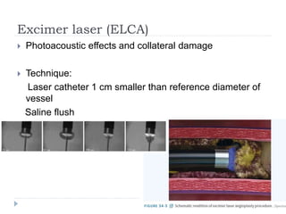 Excimer laser (ELCA)
 Photoacoustic effects and collateral damage
 Technique:
Laser catheter 1 cm smaller than reference diameter of
vessel
Saline flush
Slow catheter advancement at 0.2 mm/s → maximal
ablation
 