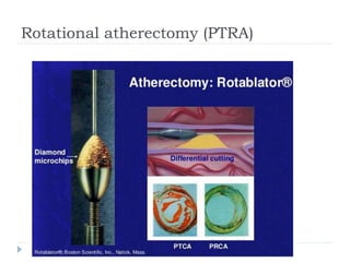 Rotational atherectomy (PTRA)
 