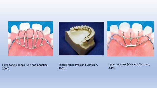 Crib Or Rake ADJUSTABLE TONGUE CRIB.pptx | Dental Health | Diseases and Conditions
