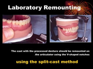 Split Cast Method Adjustment of complete denture occlusion.ppt