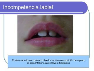 Labio Reposo Anomalia dentomaxilar | PPT