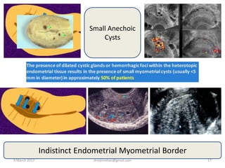 Small Anechoic
Cysts
Indistinct Endometrial Myometrial Border
9 March 2017 drrejimohan@gmail.com 17
 