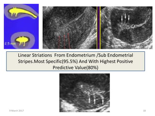 Linear Striations From Endometrium /Sub Endometrial
Stripes.Most Specific(95.5%) And With Highest Positive
Predictive Value(80%)
9 March 2017 drrejimohan@gmail.com 18
 