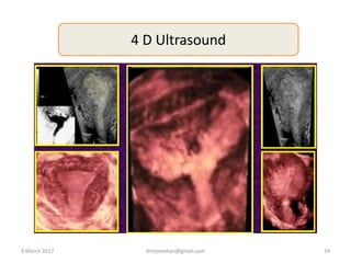 4 D Ultrasound
9 March 2017 drrejimohan@gmail.com 19
 
