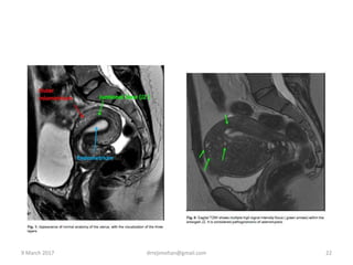 9 March 2017 drrejimohan@gmail.com 22
 