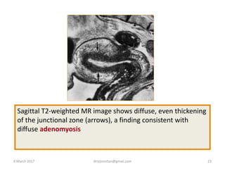 Sagittal T2-weighted MR image shows diffuse, even thickening
of the junctional zone (arrows), a finding consistent with
diffuse adenomyosis
9 March 2017 drrejimohan@gmail.com 23
 
