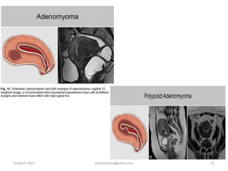 9 March 2017 drrejimohan@gmail.com 25
 
