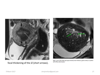 focal thickening of the JZ (short arrows).
9 March 2017 drrejimohan@gmail.com 27
 