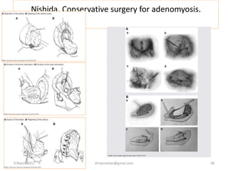 Nishida. Conservative surgery for adenomyosis.
9 March 2017 drrejimohan@gmail.com 38
 