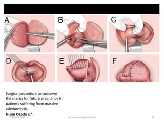 Surgical procedure to conserve
the uterus for future pregnancy in
patients suffering from massive
adenomyosis
Hisao Osada a,*,
9 March 2017 drrejimohan@gmail.com 39
 