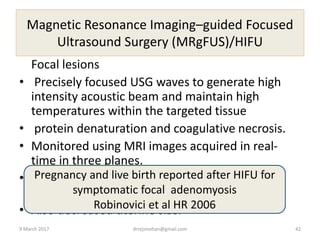 Magnetic Resonance Imaging–guided Focused
Ultrasound Surgery (MRgFUS)/HIFU
Focal lesions
• Precisely focused USG waves to generate high
intensity acoustic beam and maintain high
temperatures within the targeted tissue
• protein denaturation and coagulative necrosis.
• Monitored using MRI images acquired in real-
time in three planes.
• Significant reduction in menorrhagia and
dysmennorhea .
• Also decreased uterine size.
Pregnancy and live birth reported after HIFU for
symptomatic focal adenomyosis
Robinovici et al HR 2006
9 March 2017 drrejimohan@gmail.com 42
 