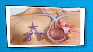 Administering medications by intravenous bolus or push | PPTX