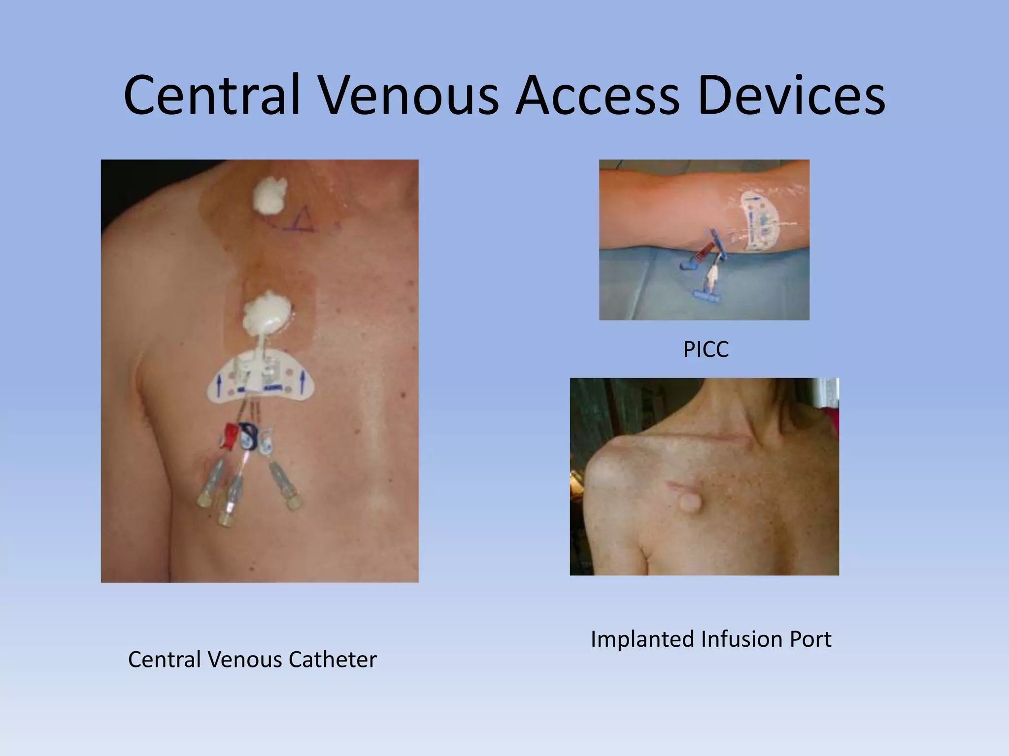 Central Venous Access DevicesPICCImplanted Infusion PortCentral Venous Catheter
