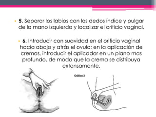 • 5. Separar los labios con los dedos índice y pulgar 
de la mano izquierda y localizar el orificio vaginal. 
• 6. Introducir con suavidad en el orificio vaginal 
hacia abajo y atrás el ovulo; en la aplicación de 
cremas, introducir el aplicador en un plano mas 
profundo, de modo que la crema se distribuya 
extensamente. 
 