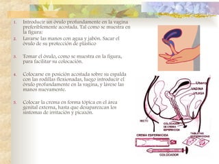 1. Introducir un óvulo profundamente en la vagina
preferiblemente acostada. Tal como se muestra en
la figura:
2. Lavarse las manos con agua y jabón. Sacar el
óvulo de su protección de plástico
3. Tomar el óvulo, como se muestra en la figura,
para facilitar su colocación.
4. Colocarse en posición acostada sobre su espalda
con las rodillas flexionadas, luego introducir el
óvulo profundamente en la vagina, y lávese las
manos nuevamente.
5. Colocar la crema en forma tópica en el área
genital externa, hasta que desaparezcan los
síntomas de irritación y picazón.
 