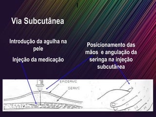 I
Posicionamento das
mãos e angulação da
seringa na injeção
subcutânea
Introdução da agulha na
pele
Injeção da medicação
Via Subcutânea
 