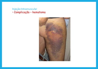 Injeção Intramuscular
• Complicação – hematoma
 