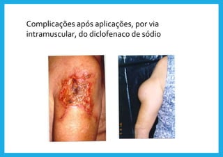 Complicações após aplicações, por via
intramuscular, do diclofenaco de sódio
 