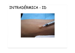 INTRADÉRMICA - ID
 