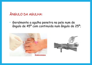 ÂNGULO DA AGULHA:
• Geralmente a agulha penetra na pele num de
ângulo de 45º com continuida num ângulo de 25º;
 