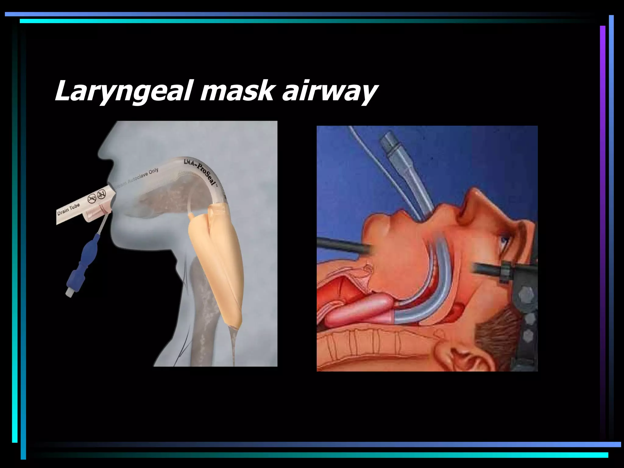 Laryngeal mask airway 