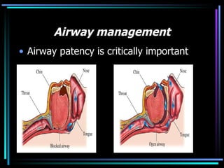 Airway management Airway patency is critically important 