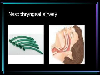 Nasophryngeal airway 