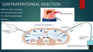 Intraperitoneal Injection Route ADMINISTRATION OF INJECTION by ram.pptx