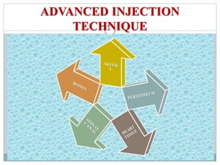 ADVANCED INJECTION
TECHNIQUE
 