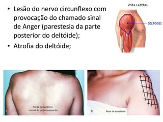 • Lesão do nervo circunflexo com
provocação do chamado sinal
de Anger (parestesia da parte
posterior do deltóide);
• Atrofia do deltóide;
 