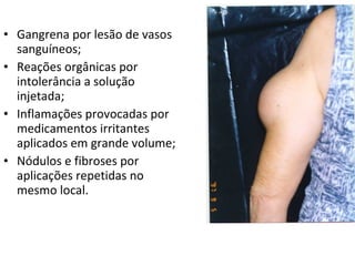 • Gangrena por lesão de vasos
sanguíneos;
• Reações orgânicas por
intolerância a solução
injetada;
• Inflamações provocadas por
medicamentos irritantes
aplicados em grande volume;
• Nódulos e fibroses por
aplicações repetidas no
mesmo local.
 
