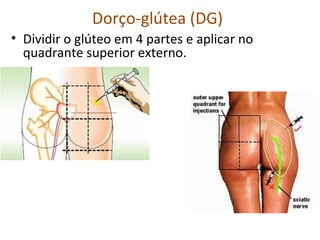 Dorço-glútea (DG)
• Dividir o glúteo em 4 partes e aplicar no
quadrante superior externo.
 