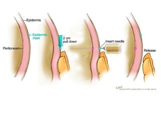 Adm med via intramuscular