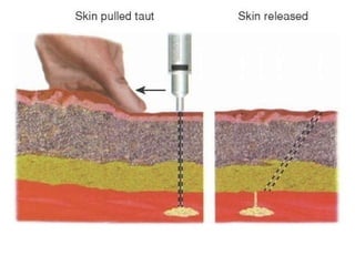 Adm med via intramuscular