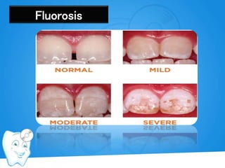 Fluorosis
 