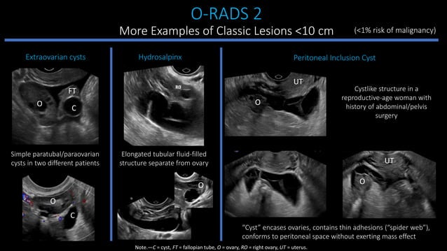 Adnexal cysts.pptx | Menopause | Endocrine and Metabolic Diseases