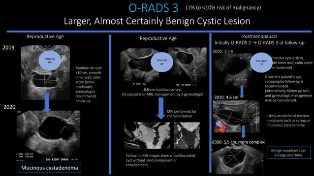 Adnexal cysts.pptx | Menopause | Endocrine and Metabolic Diseases