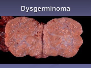 Dysgerminoma 